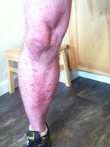 psoriasis before